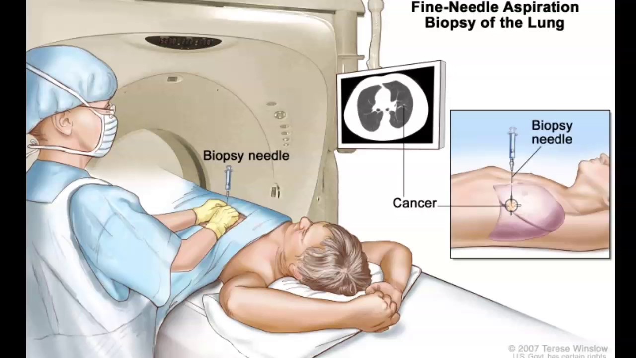 CT Guided Biopsy